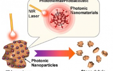 Nano Letters：光子碎石术—近红外激光活化纳米材料可用于肾结石粉碎