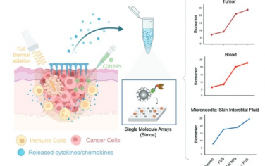 Advanced Functional Materials：利用微针和超灵敏单分子阵列监测黑色素瘤对STING激动剂和聚焦超声热消融的反应